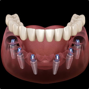Denture being placed onto six dental implants