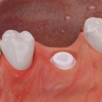 Mini dental implant in the space between two teeth