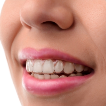 Close up of person with Invisalign aligner over their upper teeth