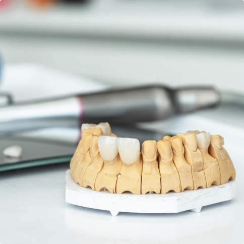 Model of the mouth with dental crowns and bridges on some teeth