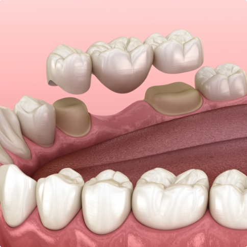 Illustrated dental bridge replacing a missing tooth in Weatherford