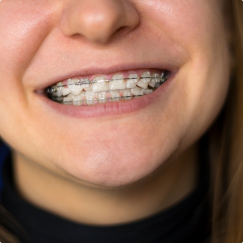 Close up of person smiling with traditional braces in Weatherford