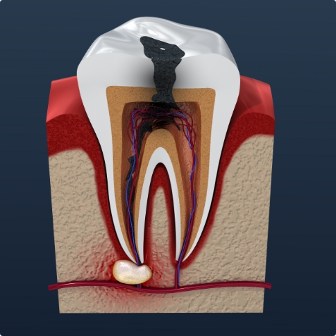 Illustrated damaged tooth needing root canal treatment in Weatherford