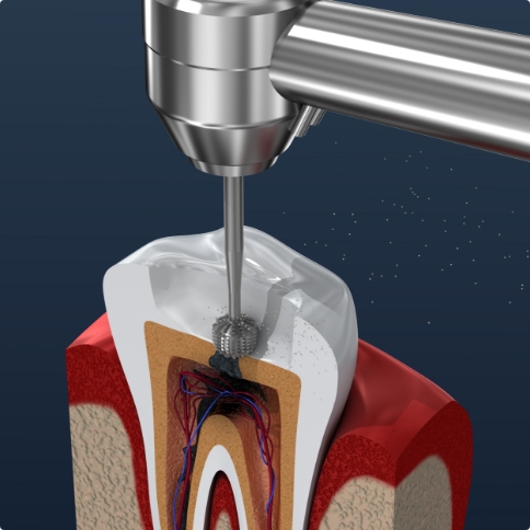 Illustrated dental instrument performing a root canal