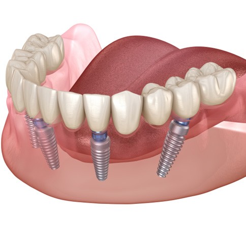 Illustration of All on 4 dental implants in Weatherford replacing a lower arch of teeth