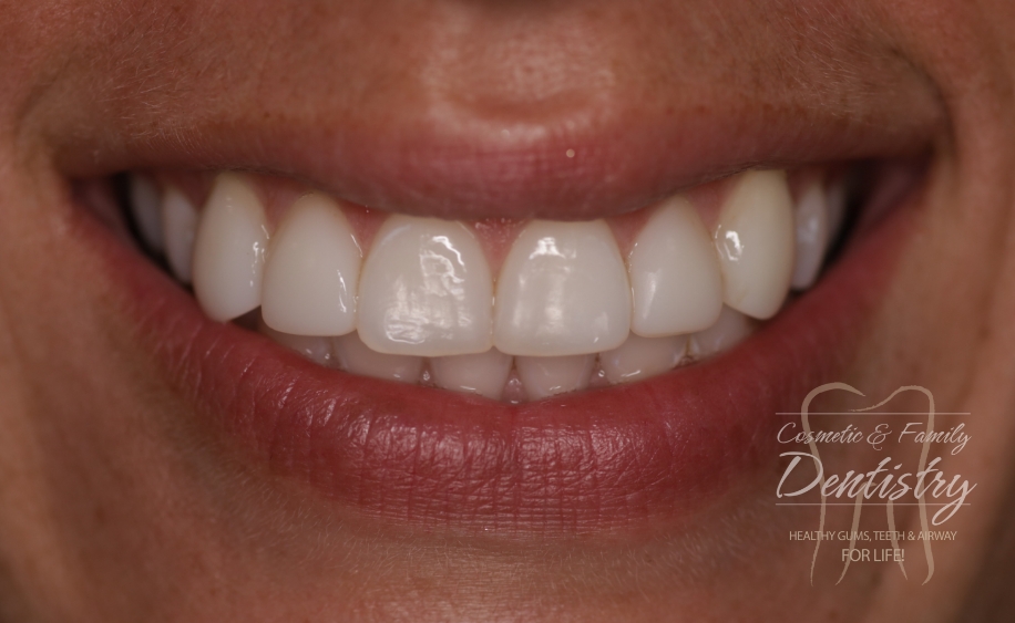 Close up of flawless smile after Bioclear dental bonding