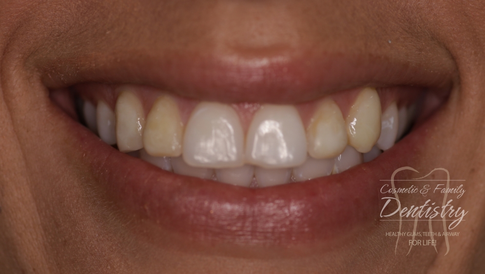 Close up of imperfect teeth before Bioclear dental bonding