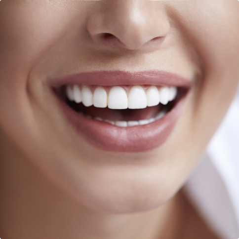 Close up of person with flawless smile after Bioclear dental bonding in Weatherford