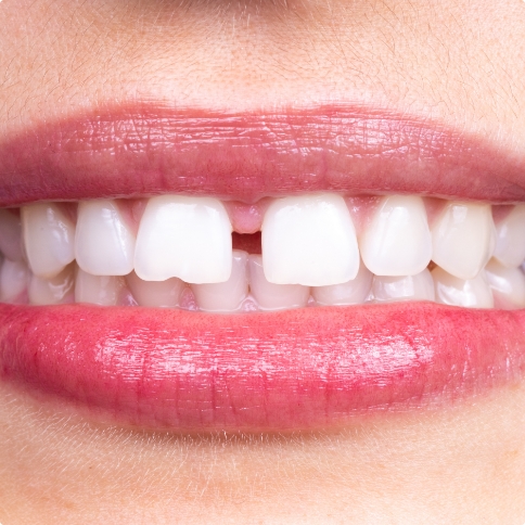 Close up of smile with small gap between two front teeth