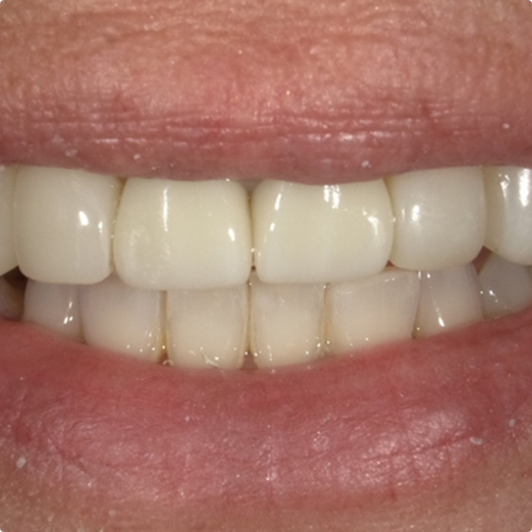 Using Bioclear bonding to address a deep cary in tooth