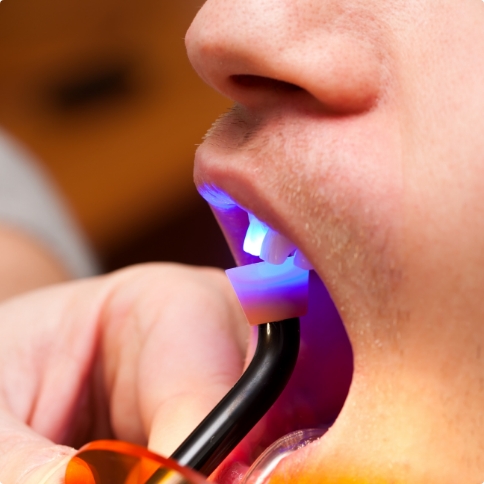 Dental patient getting direct bonding on a tooth