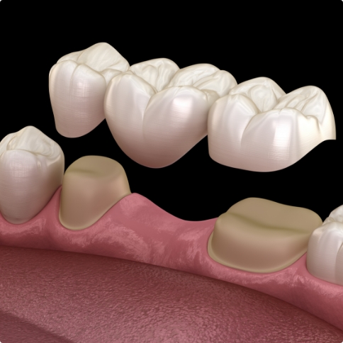 Illustrated dental bridge in Weatherford being placed in the mouth