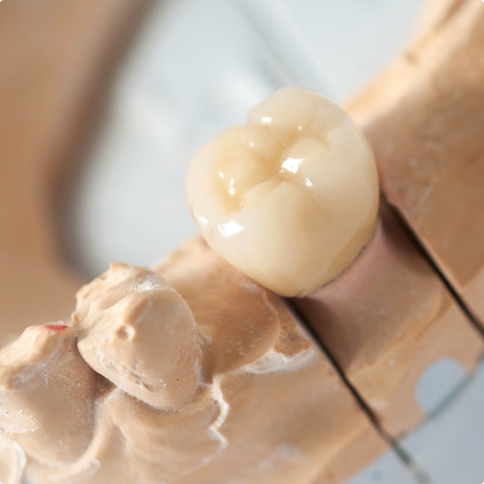 Model of a mouth with a dental crown in Weatherford over one tooth
