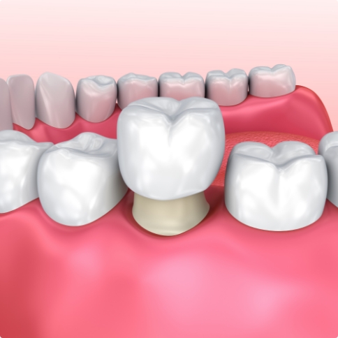 Illustrated dental crown being fitted over a tooth