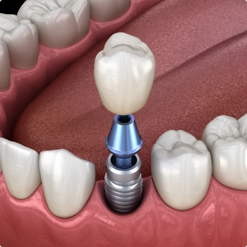 Dental crown being placed onto a dental implant