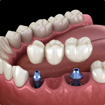 Dental bridge being placed onto two dental implants