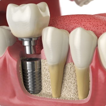 Diagram showing single tooth dental implant in Weatherford