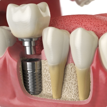 Illustrated dental crown being fitted onto a dental implant