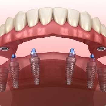 Illustrated full denture being fitted onto six dental implants