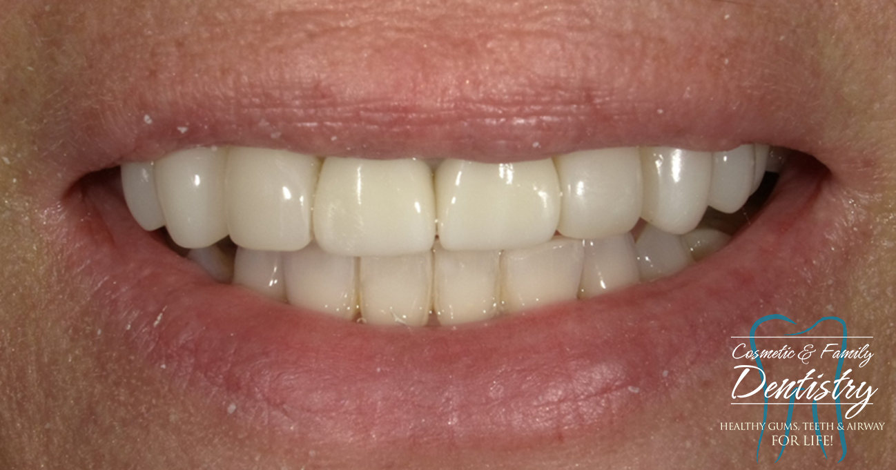 Close up of flawless smile after Bioclear dental bonding