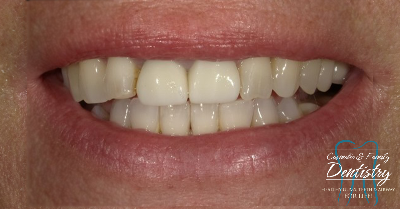 Close up of imperfect teeth before Bioclear dental bonding