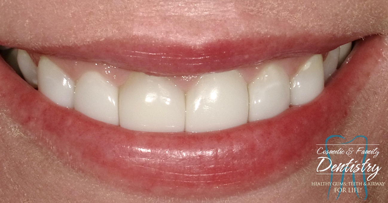 Close up of flawless smile after Bioclear dental bonding