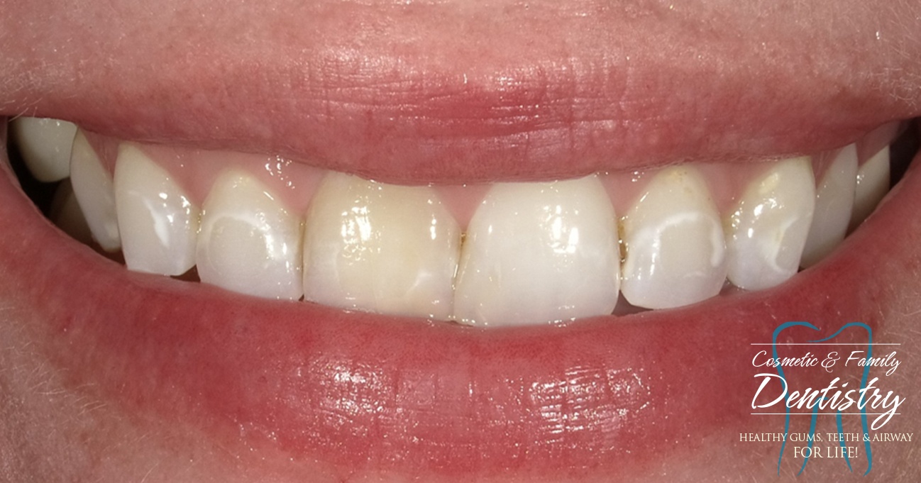 Close up of imperfect teeth before Bioclear dental bonding