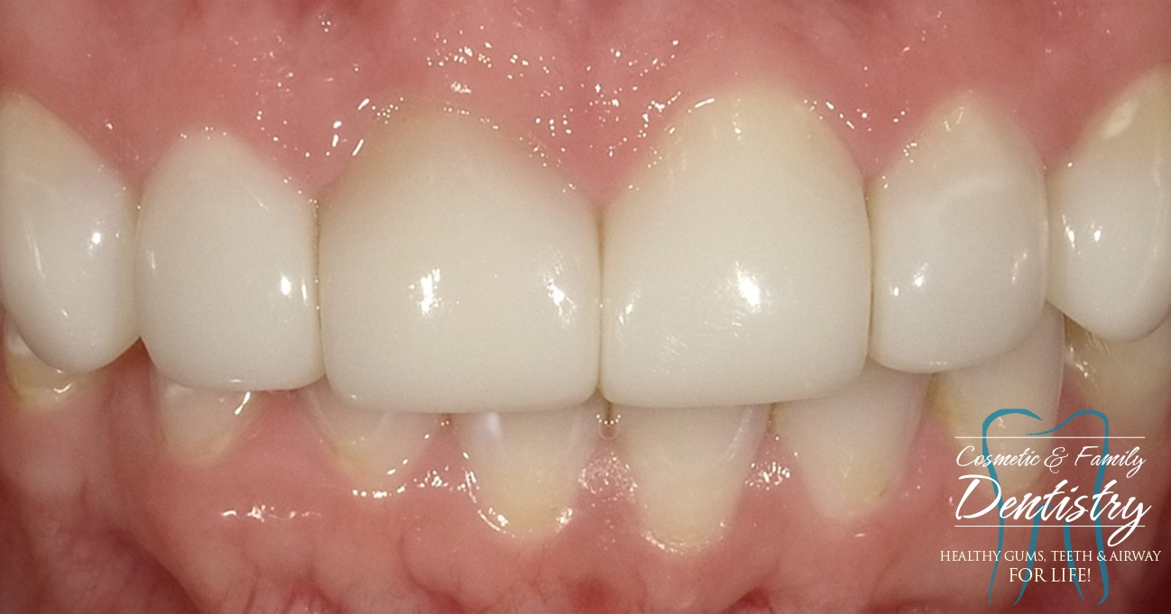 Close up of flawless smile after Bioclear dental bonding