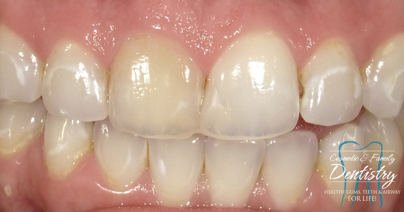 Close up of imperfect teeth before Bioclear dental bonding