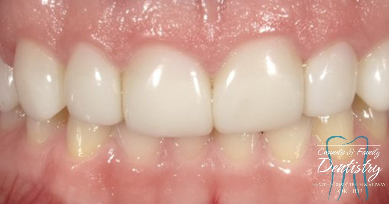 Close up of flawless smile after Bioclear dental bonding