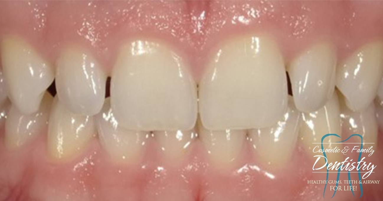 Close up of imperfect teeth before Bioclear dental bonding