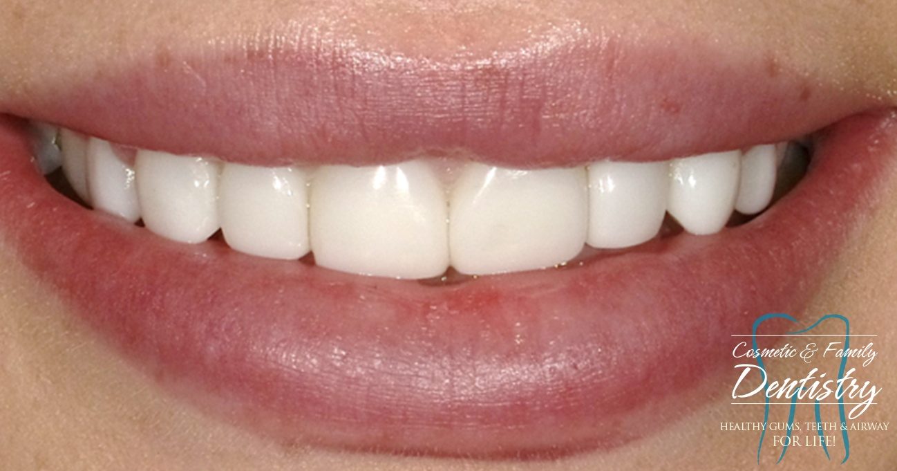 Close up of flawless smile after Bioclear dental bonding