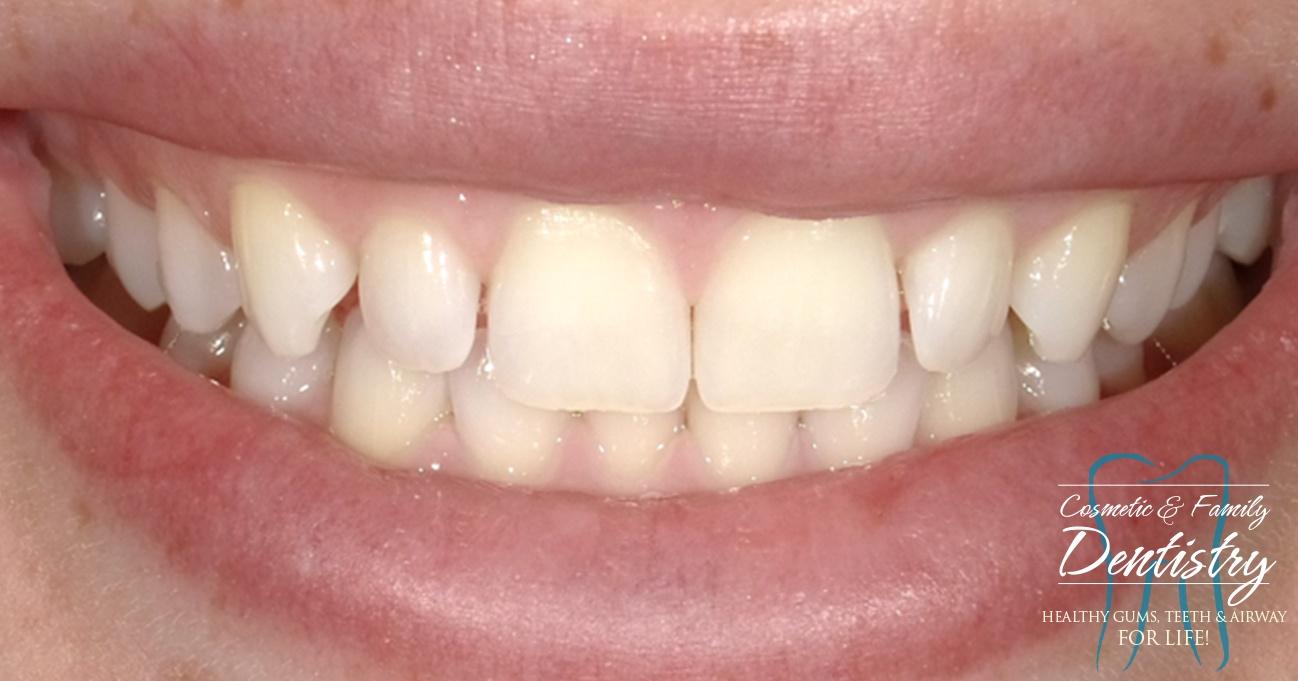 Close up of imperfect teeth before Bioclear dental bonding