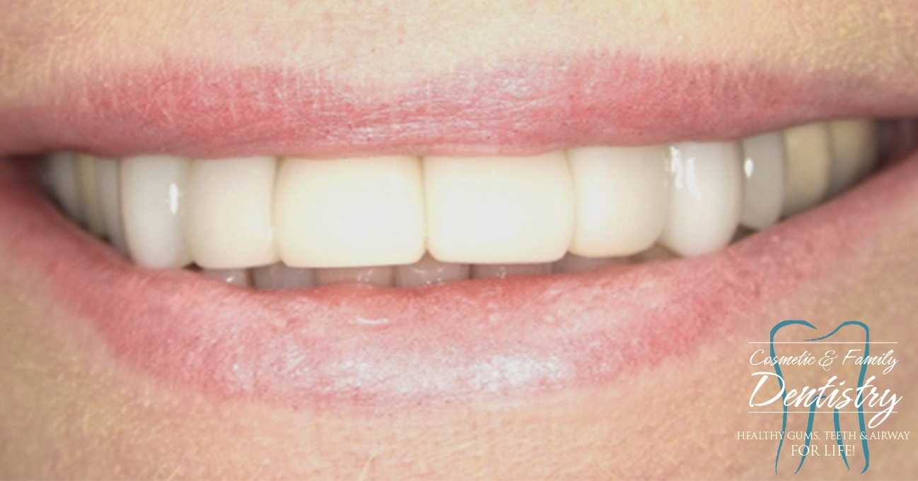 Close up of flawless smile after Bioclear dental bonding