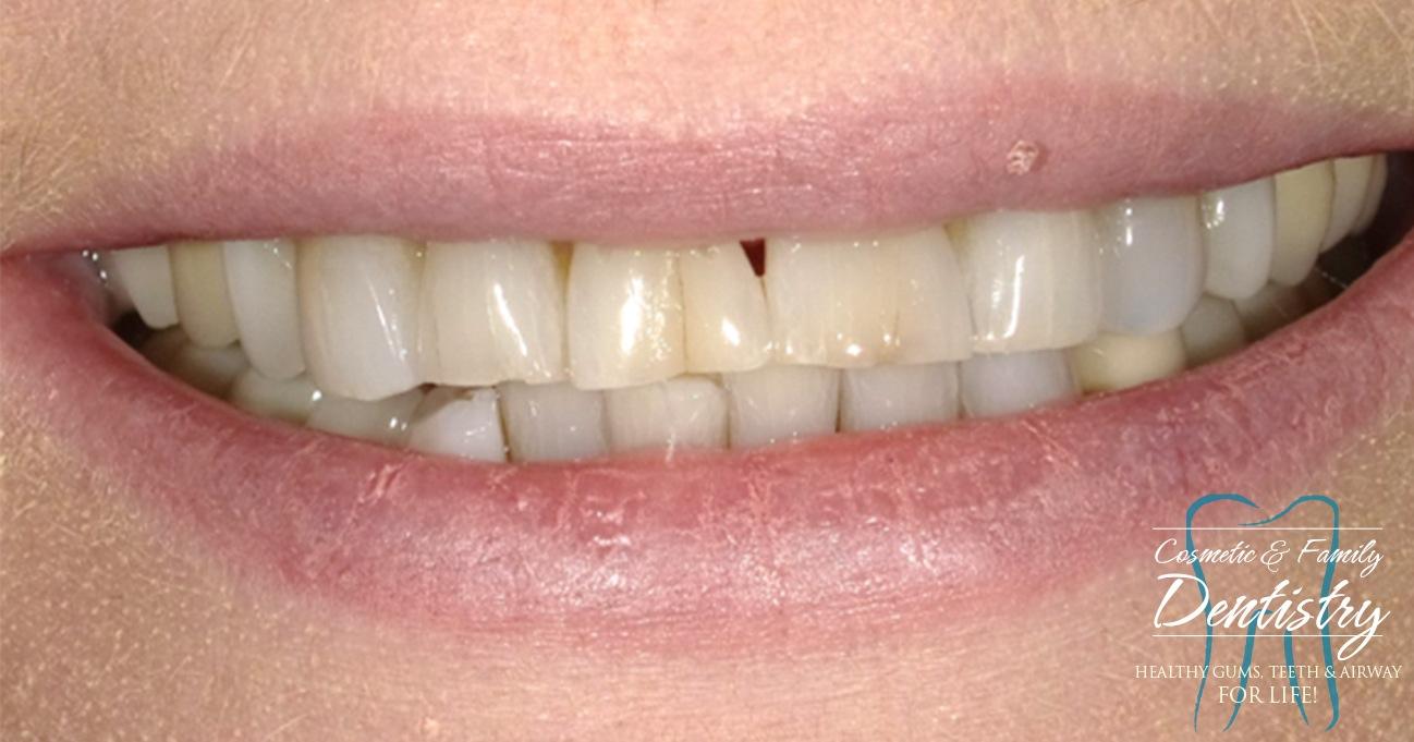 Close up of imperfect teeth before Bioclear dental bonding