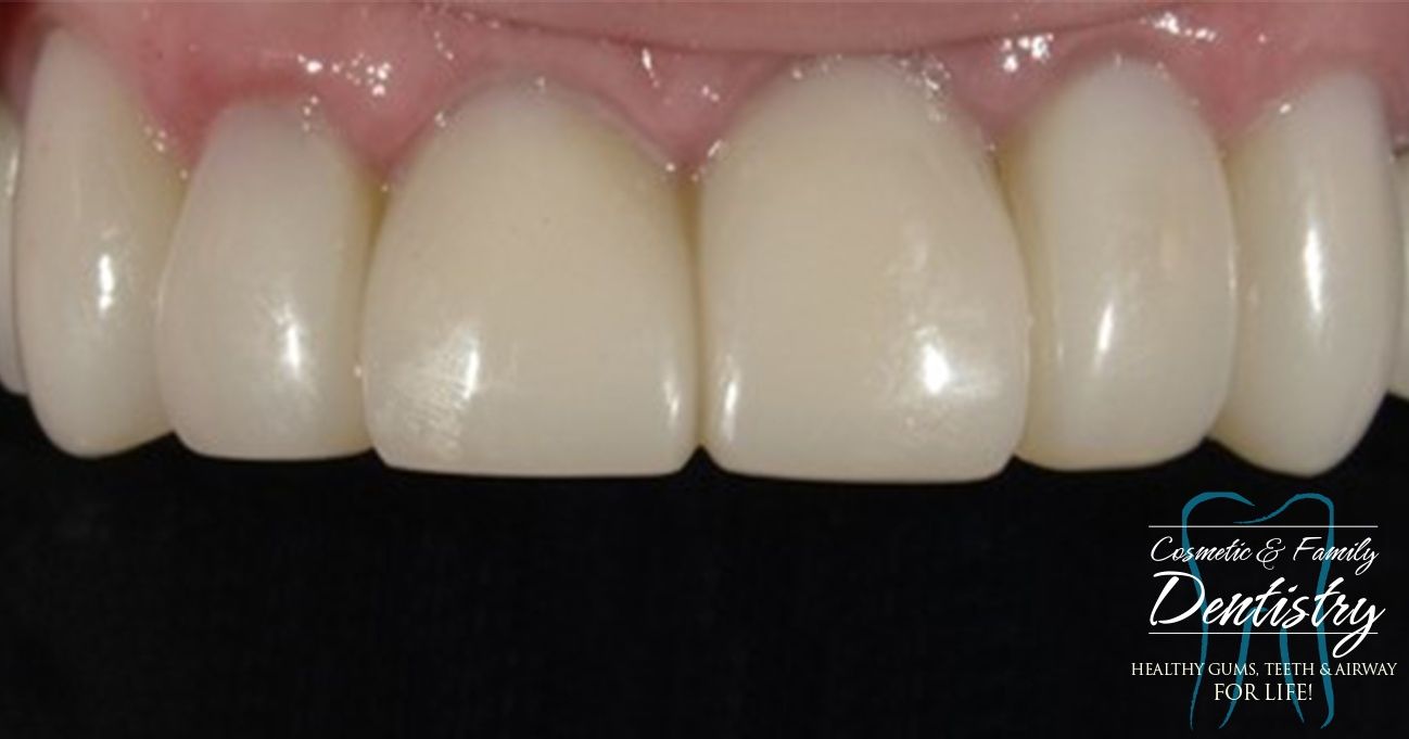 Close up of flawless smile after Bioclear dental bonding