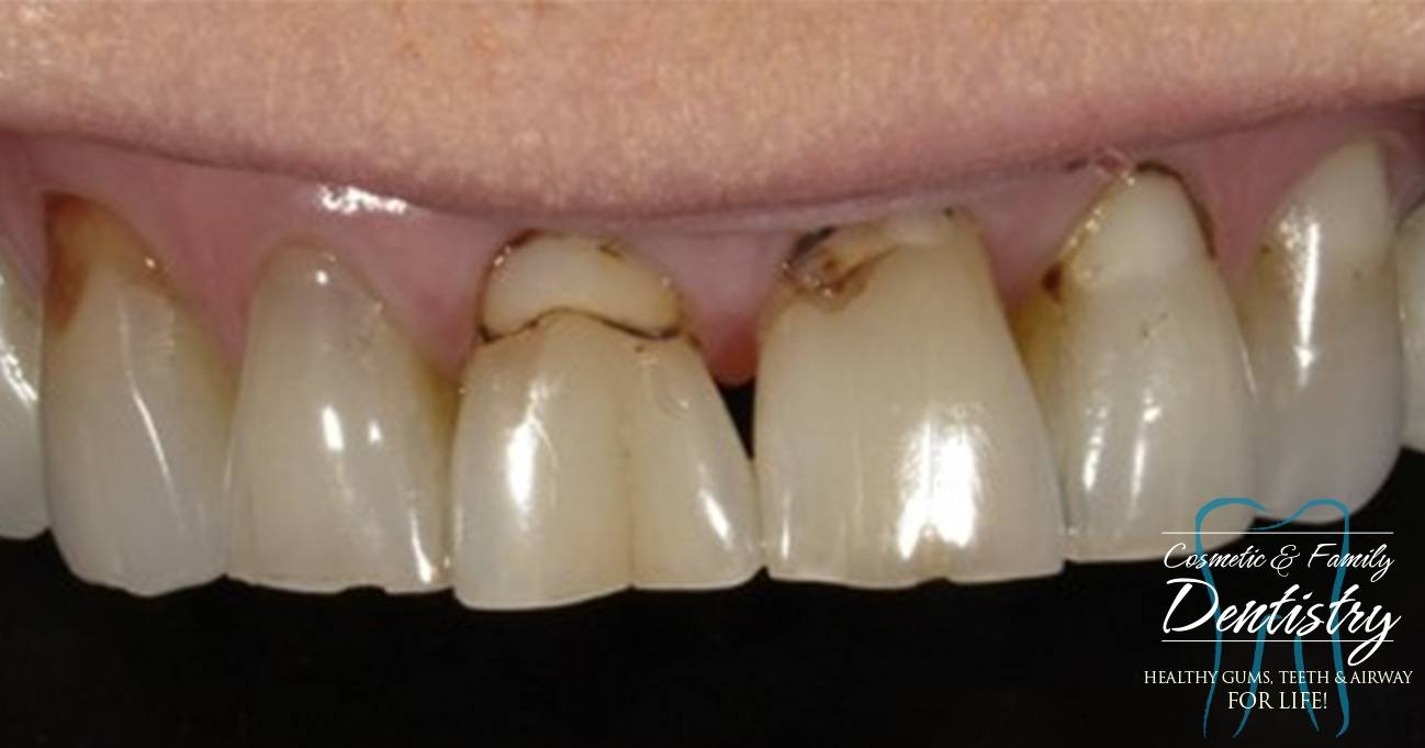 Close up of imperfect teeth before Bioclear dental bonding