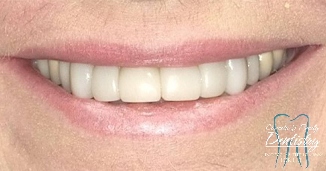 Close up of flawless smile after Bioclear dental bonding