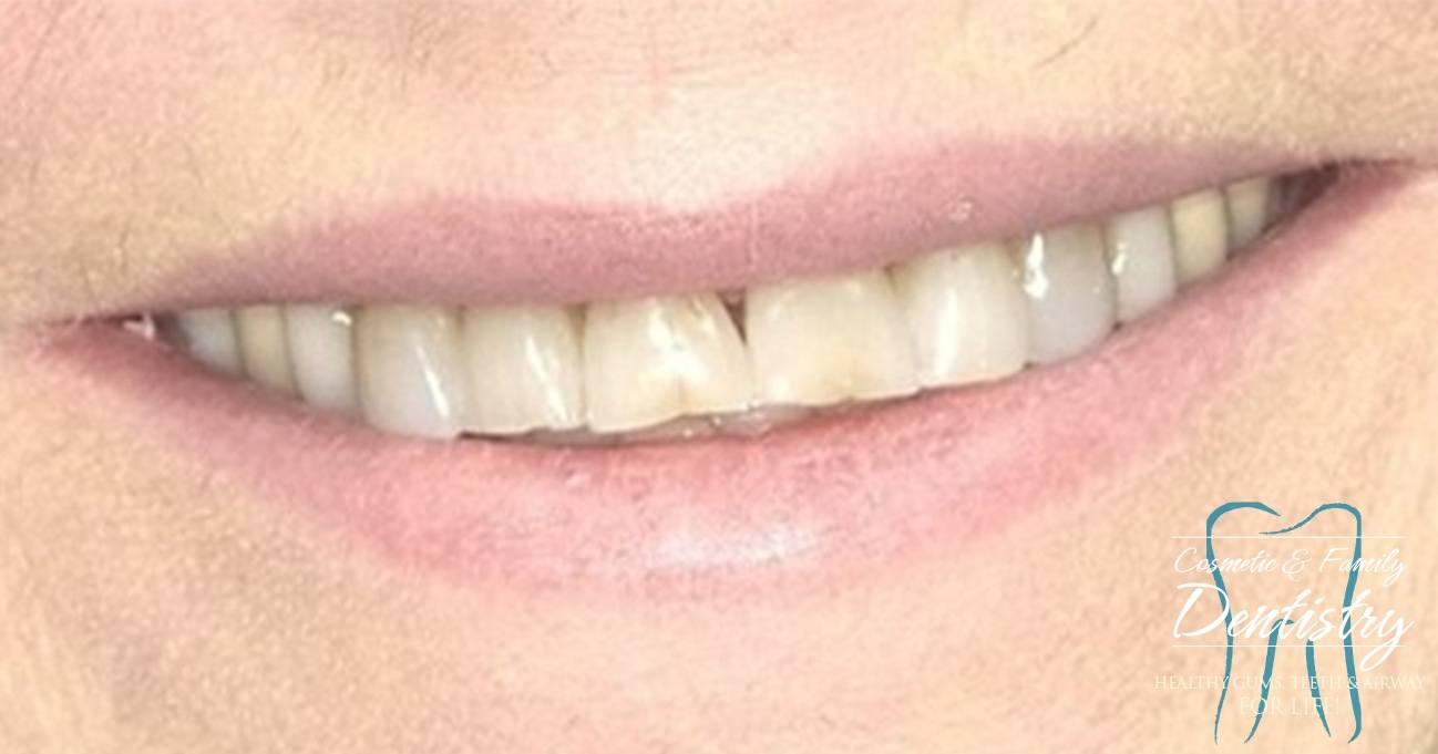 Close up of imperfect teeth before Bioclear dental bonding