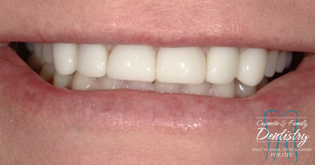 Close up of flawless smile after Bioclear dental bonding