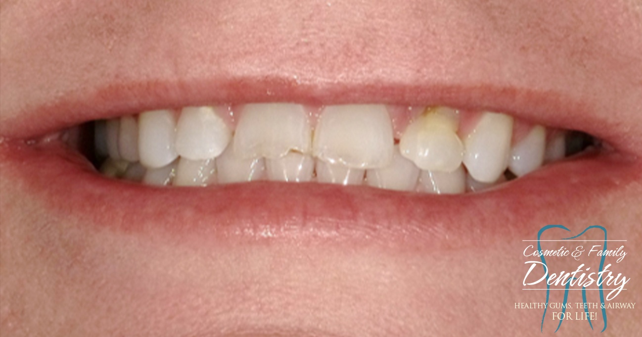 Close up of imperfect teeth before Bioclear dental bonding