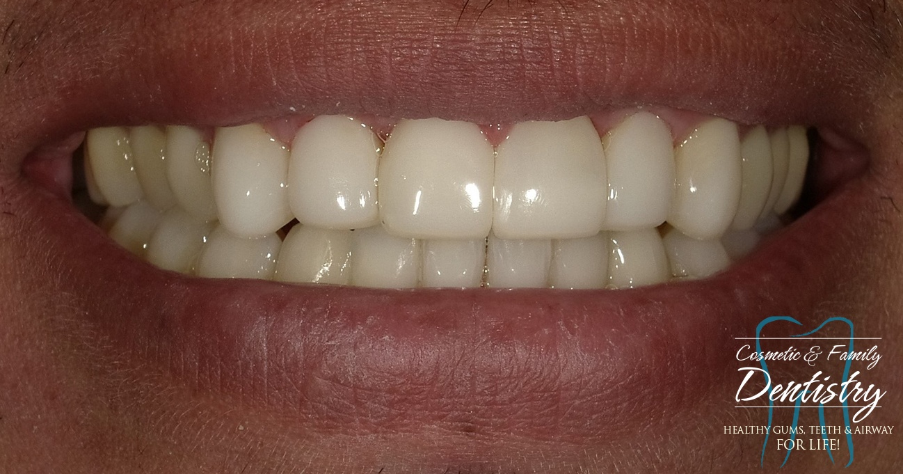 Close up of flawless smile after Bioclear dental bonding