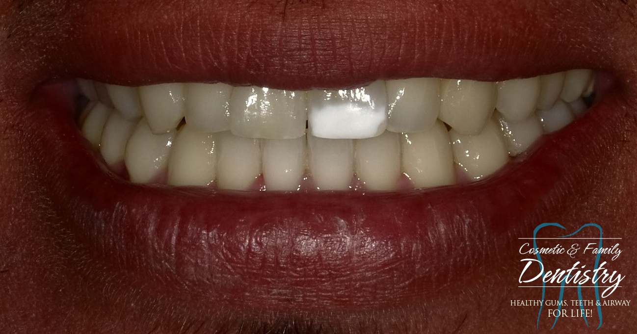 Close up of imperfect teeth before Bioclear dental bonding