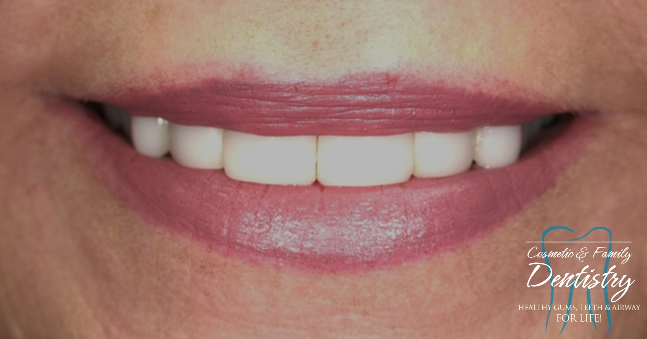 Close up of flawless smile after Bioclear dental bonding