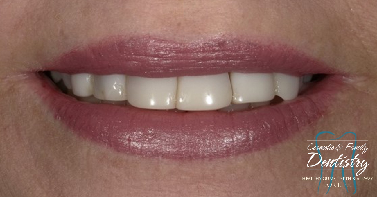 Close up of imperfect teeth before Bioclear dental bonding