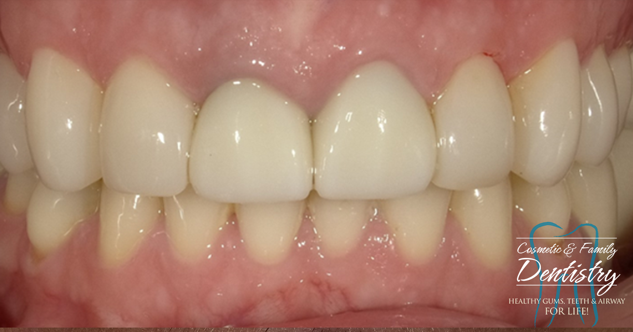 Close up of flawless smile after Bioclear dental bonding