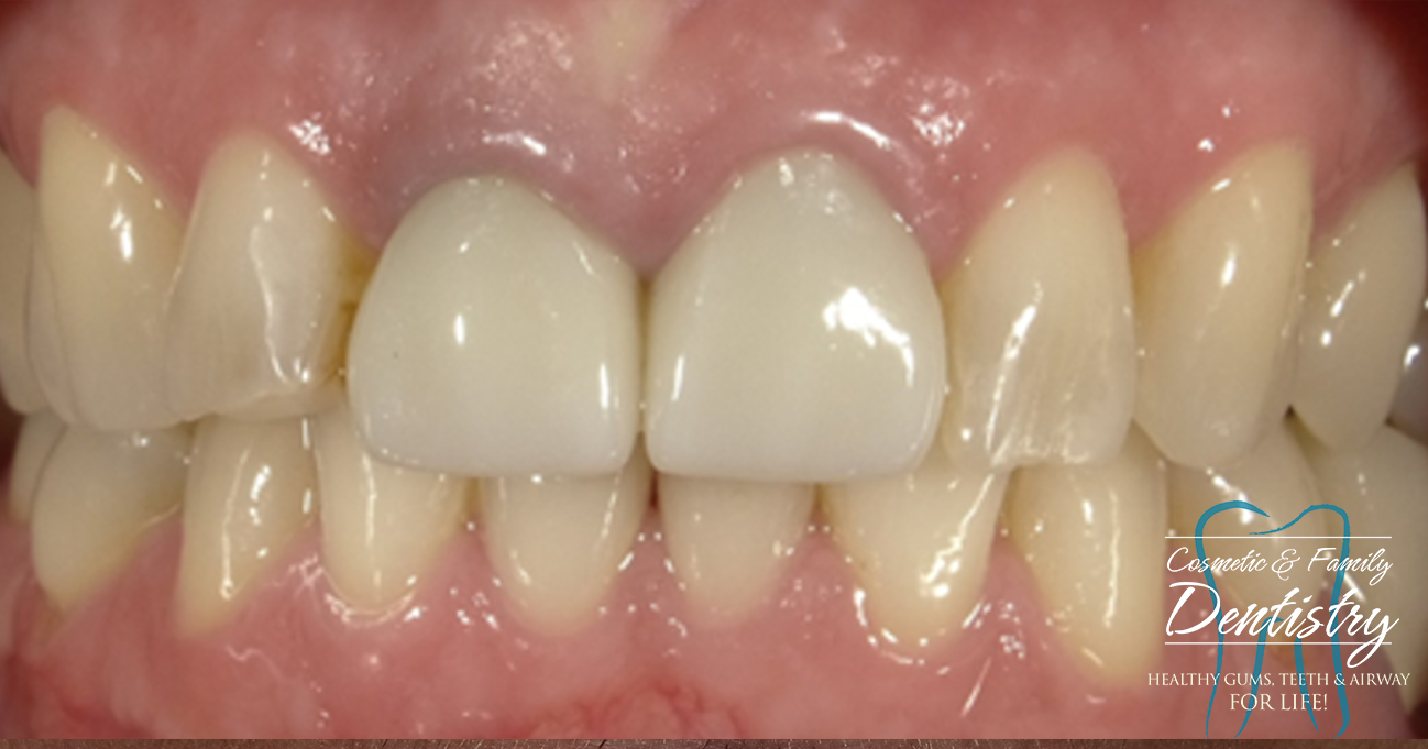 Close up of imperfect teeth before Bioclear dental bonding