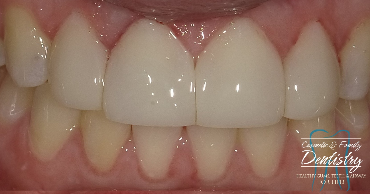 Close up of flawless smile after Bioclear dental bonding