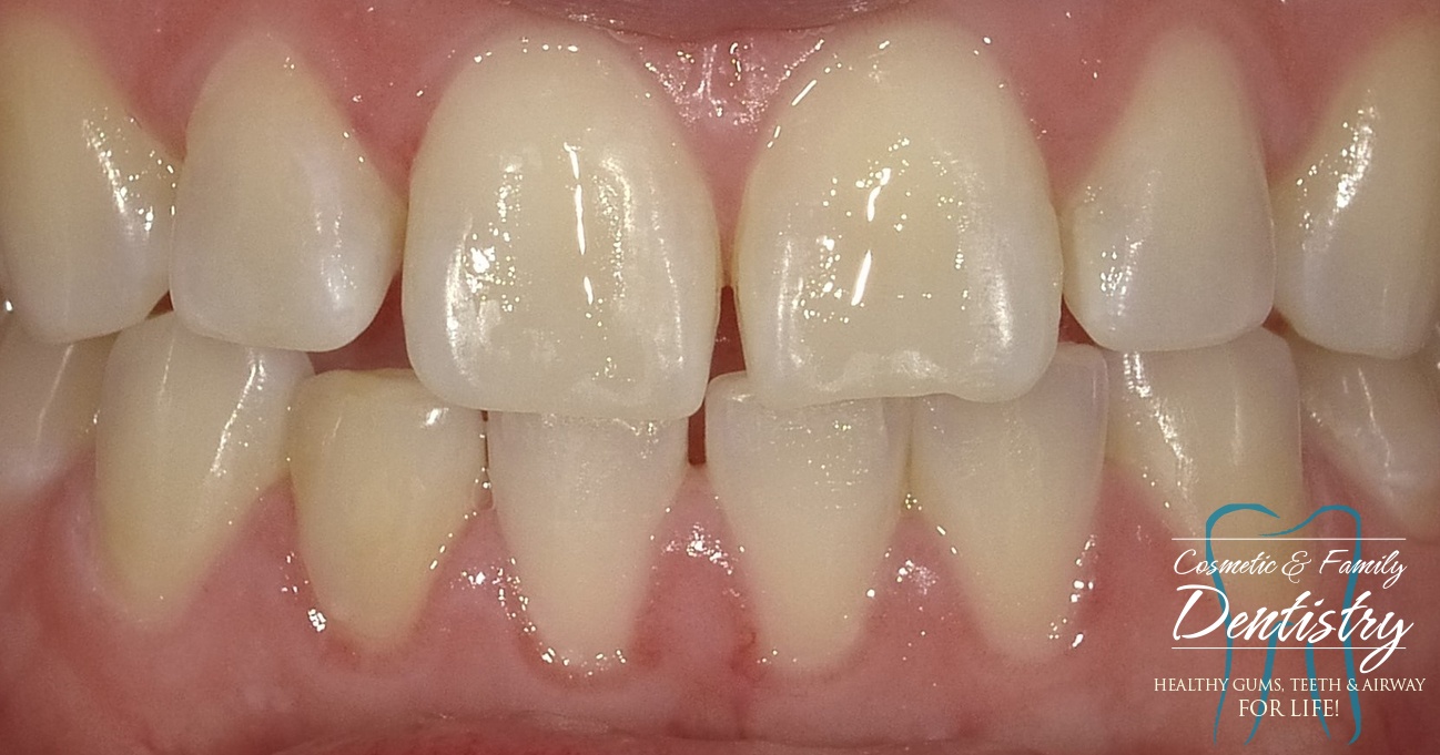 Close up of imperfect teeth before Bioclear dental bonding