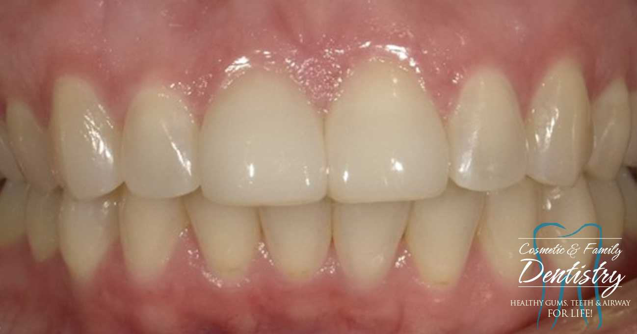 Close up of flawless smile after Bioclear dental bonding